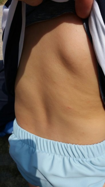 Neurodermitis am Rücken nach Behandlung mit LetiAT4