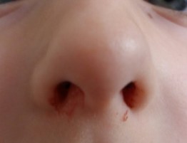 LetiBalm hilft wunden Nasen