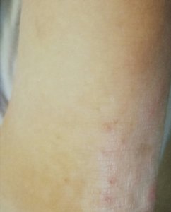 Neurodermitis Fuß vorher